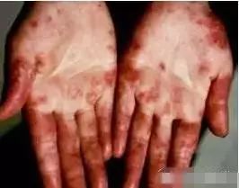 食用菌產(chǎn)品的神奇見證 白癲風(fēng) 牛皮癬 紅斑狼瘡