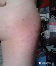 牛皮癬的克星 講述一位嚴(yán)重牛皮癬康復(fù)過程