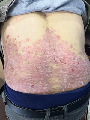 銀屑病牛皮癬是&ldquo;辛苦&rdquo;出來的