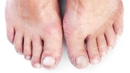 銀屑病的臨床表現(xiàn)及類型