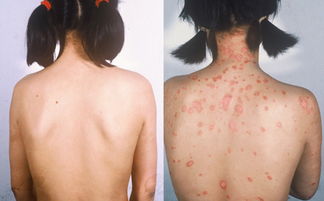 牛皮癬早期會有哪些癥狀