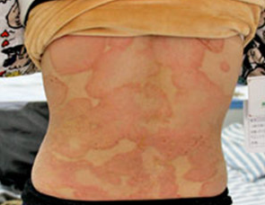 銀屑病（牛皮癬）的治療方法及管理策略