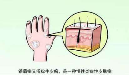 牛皮癬的病因與發病機制解析