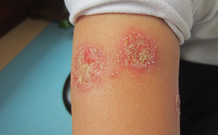 膿皰性牛皮癬概述 癥狀、類型與治療方法詳解