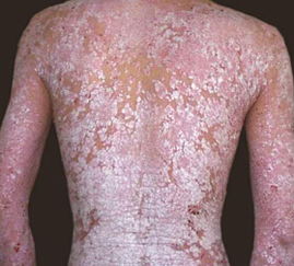 男性紅皮病型牛皮癬的預防措施與注意事項