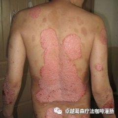 牛皮癬患者的福音 新希望與科學進展