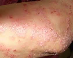 血虛型牛皮癬的成因、癥狀與中醫治療調理