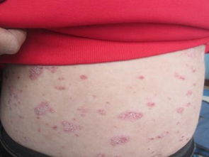 牛皮癬做好日常護理的重要性