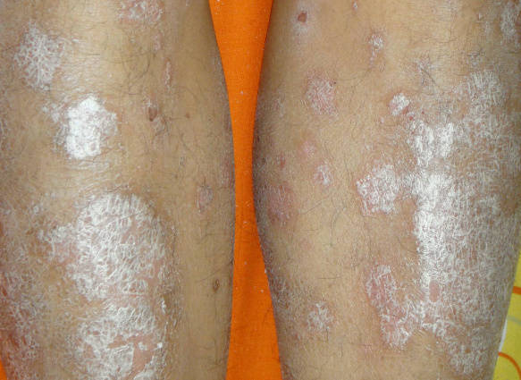 身上長白花花的牛皮癬是什么原因引起的？