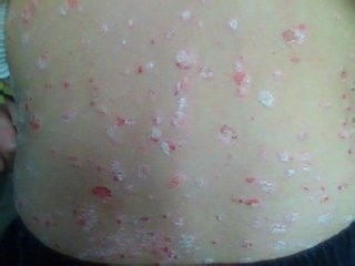 牛皮癬復發的治療策略與應對方法