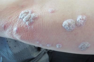 牛皮癬早期癥狀詳解 識別早期信號，科學應對