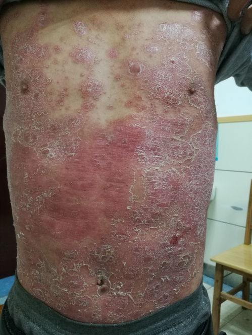 銀屑病（牛皮癬）治療病例分享 從困擾到緩解的歷程