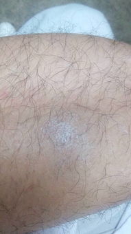 關于牛皮癬的基本介紹