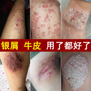牛皮成人外用軟膏 非激素止癢良方，專治銀屑病與各種癬癥