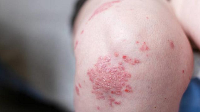 關于銀屑病（牛皮癬）的3個真相！破除誤解，科學治療