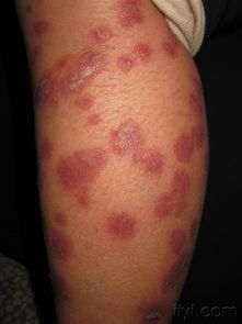 銀屑病（牛皮癬） 癥狀、病因與治療方法解析