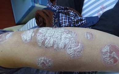 牛皮癬患者如何有效避免亞健康？