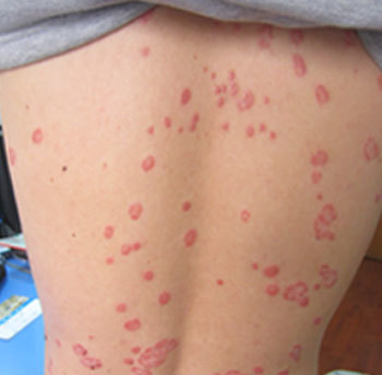 牛皮癬治療中維生素C的作用與機制