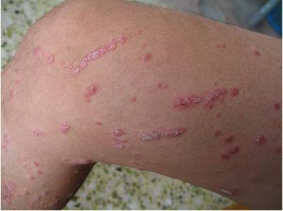 牛皮癬瘙癢反復不愈，如何科學應對與管理