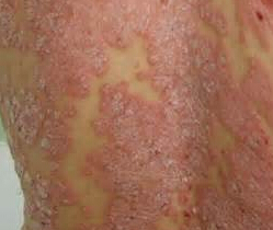 牛皮癬患者為何應(yīng)避免食用生冷食物