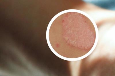 鴕鳥(niǎo)油在銀屑?。ㄅＦぐ_）治療中的認(rèn)知與局限性