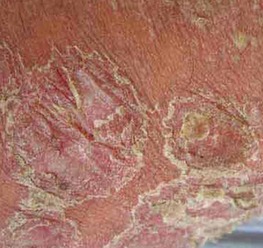 老年膿皰型牛皮癬的中醫(yī)用藥探析