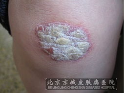 牛皮癬的病因與治療 從成因到北京?？漆t(yī)院的建議