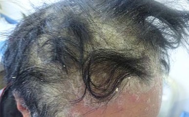 頭部銀屑病發(fā)生的主要原因探析