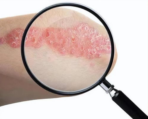 十大頑固皮膚病揭秘 濕疹僅居第六，榜首之癥愿您永不沾染