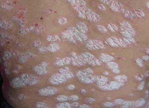 牛皮癬的危害性 不僅僅是皮膚問題