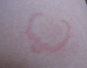 少年膿皰型牛皮癬的中醫(yī)病因探析