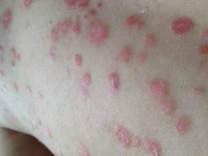 男性銀屑?。ㄅＦぐ_）常用外用藥全解析