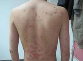 中年膿皰型牛皮癬的臨床鑒別診斷與綜合管理