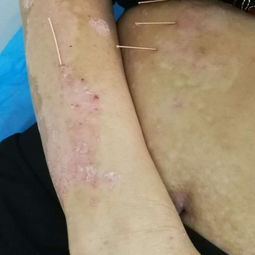 一根火針點燃三十年牛皮癬患者的希望