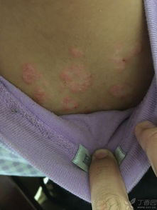 牛皮癬 不只是皮膚上的“癬”，更需科學認知與規范治療