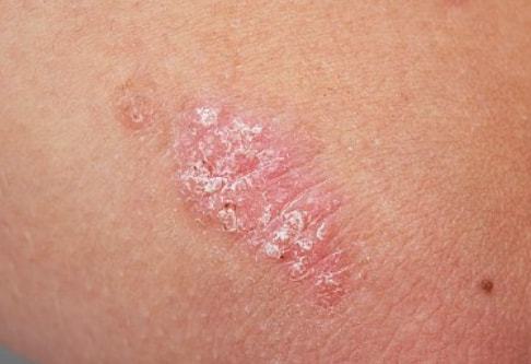 牛皮癬的“消失”與緩解 如何科學判斷銀屑病進程