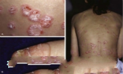 銀屑病治療前后對比 正確認識牛皮癬的改善與康復