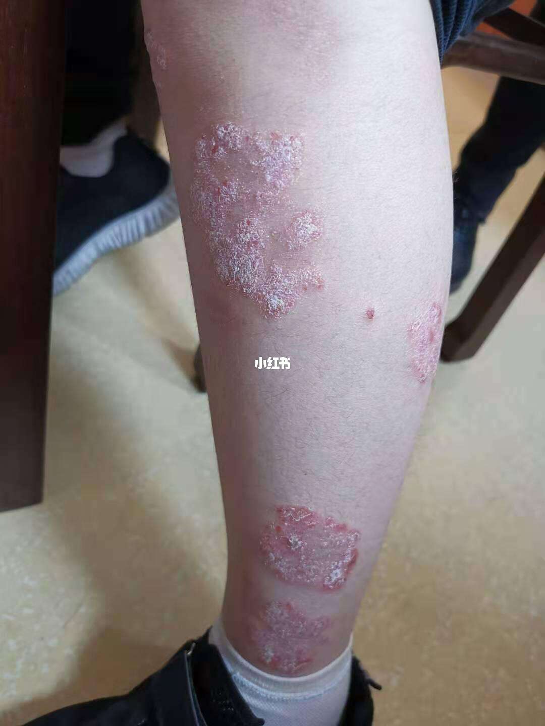 牛皮癬的病程演變 從初期征兆到后期形態的詳細對比