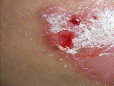 銀屑病（牛皮癬）的常見癥狀與識別