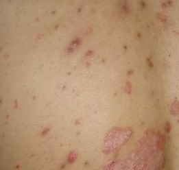 牛皮癬內服藥全解析 從傳統到生物制劑的選擇