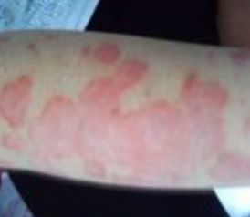 牛皮癬的民間偏方 理性看待與科學治療的重要性