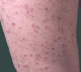 孕婦牛皮癬的科學管理與治療策略