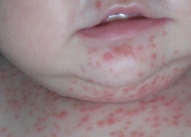 嬰兒牛皮癬與遺傳因素 揭開背后的科學(xué)聯(lián)系