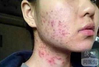 面部牛皮癬的科學(xué)治療與有效護(hù)理方法