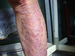 典型銀屑病皮損示例與臨床特征解析