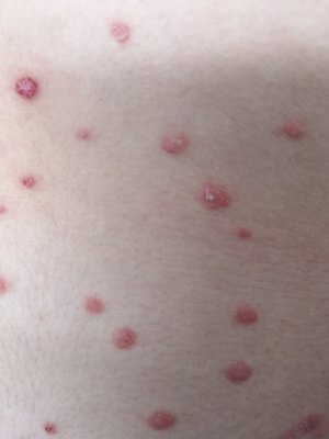 急性點滴型銀屑病 探尋“元兇”與科學認知