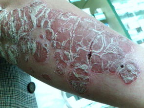 嚴重牛皮癬的視覺警示與深度解析